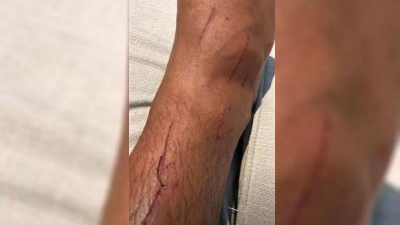 Aarón Díaz mostró cómo quedó su pierna y sus fans se preocuparon por temor a una infección. "No es nada grave", dijo el galán.